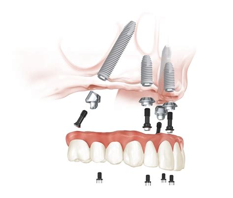 Dental implants peoria county  Dental implants are an efficient and highly effective way to replace missing teeth